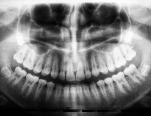 Quanto costa un impianto dentale?